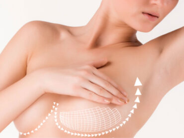 Breast Lift