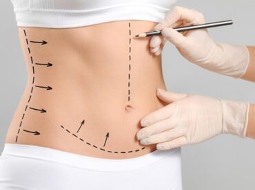 Tummy Tuck