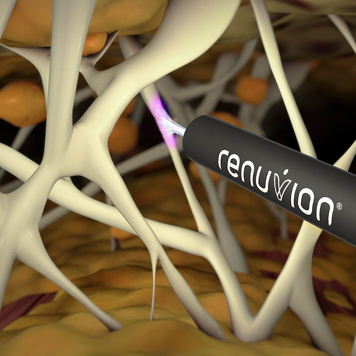 j-plasma-renuvion